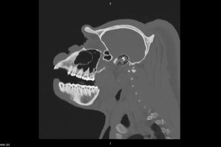 gorilla skull CT highlighting teeth
